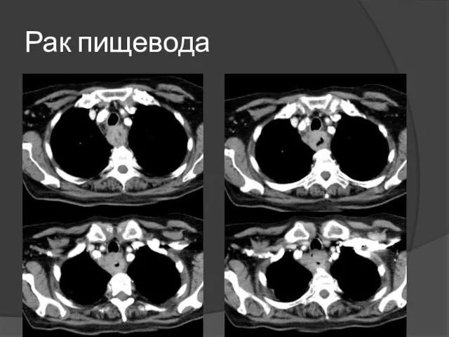 Рак пищевода