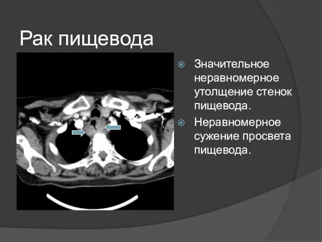 Рак пищевода Значительное неравномерное утолщение стенок пищевода. Неравномерное сужение просвета пищевода.