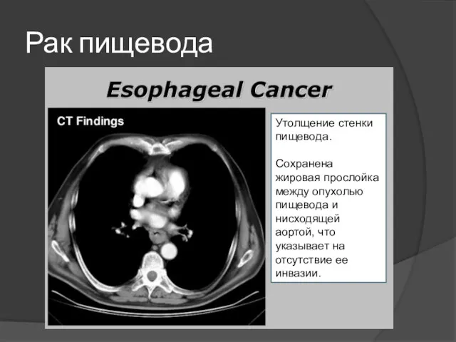 Рак пищевода Утолщение стенки пищевода. Сохранена жировая прослойка между опухолью