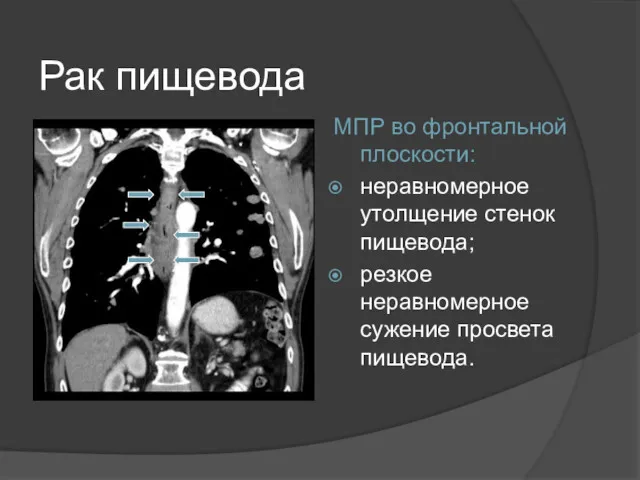 Рак пищевода МПР во фронтальной плоскости: неравномерное утолщение стенок пищевода; резкое неравномерное сужение просвета пищевода.