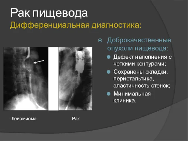 Рак пищевода Дифференциальная диагностика: Доброкачественные опухоли пищевода: Дефект наполнения с