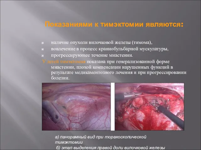 Показаниями к тимэктомии являются: наличие опухоли вилочковой железы (тимома), вовлечение в процесс краниобульбарной