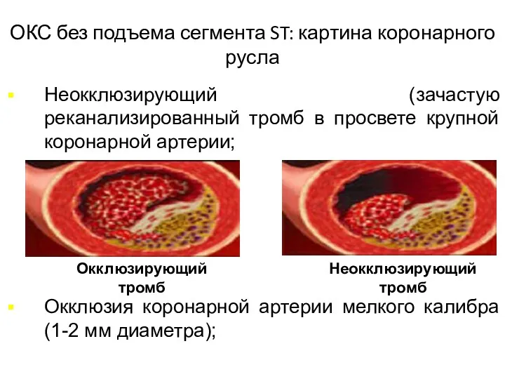 ОКС без подъема сегмента ST: картина коронарного русла Неокклюзирующий (зачастую