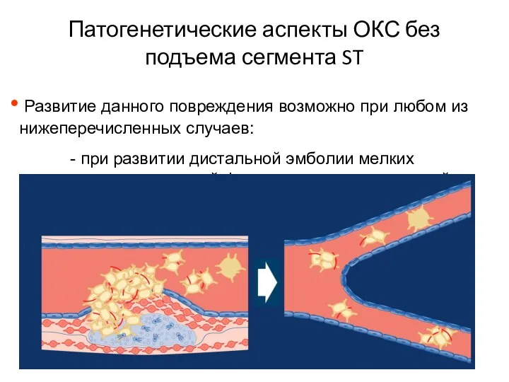 Патогенетические аспекты ОКС без подъема сегмента ST Развитие данного повреждения
