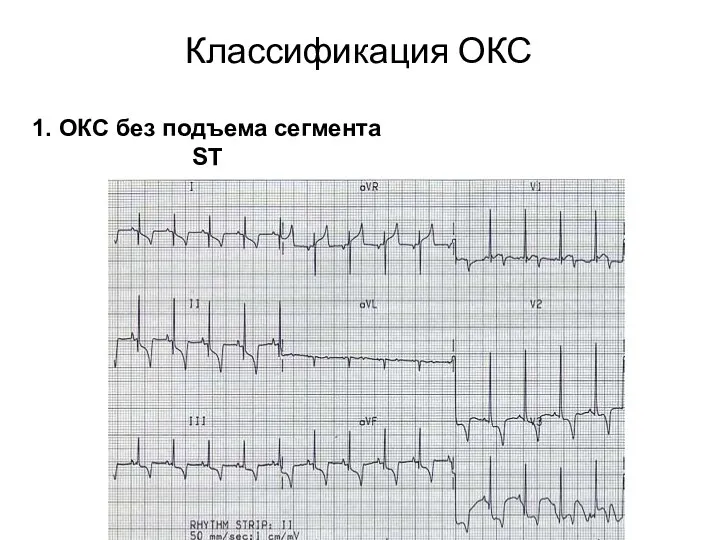 Классификация ОКС 1. ОКС без подъема сегмента ST