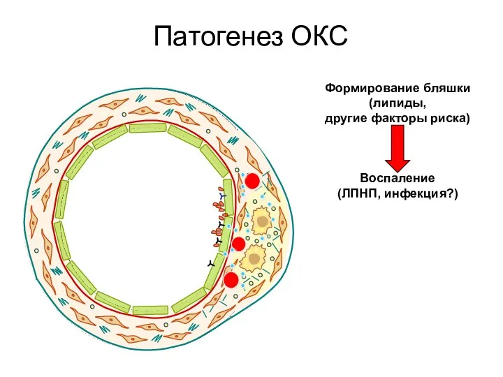 Патогенез ОКС Формирование бляшки (липиды, другие факторы риска) Воспаление (ЛПНП, инфекция?)