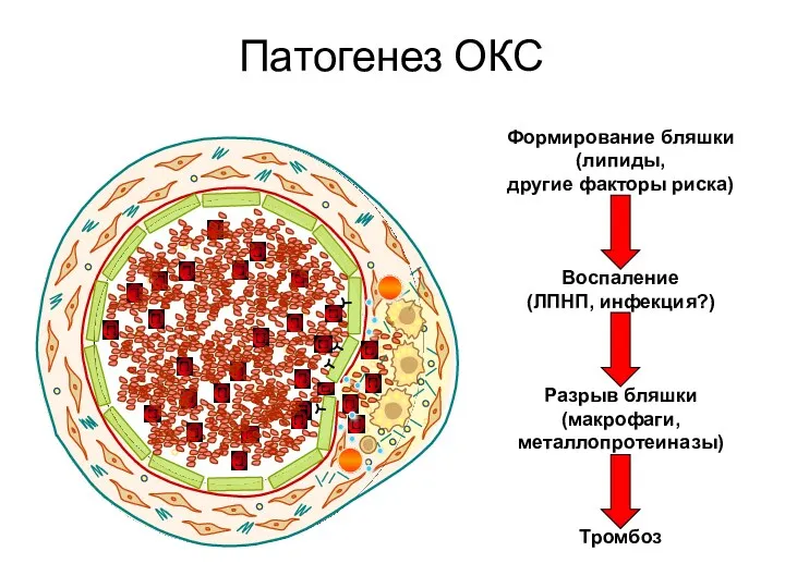 Патогенез ОКС Формирование бляшки (липиды, другие факторы риска) Воспаление (ЛПНП, инфекция?) Разрыв бляшки (макрофаги, металлопротеиназы) Тромбоз