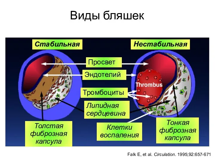 Виды бляшек Falk E, et al. Circulation. 1995;92:657-671 Стабильная Нестабильная