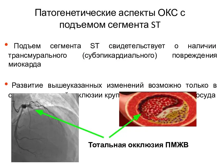 Патогенетические аспекты ОКС с подъемом сегмента ST Подъем сегмента ST