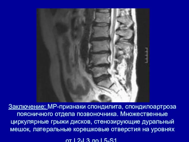 Заключение: МР-признаки спондилита, спондилоартроза поясничного отдела позвоночника. Множественные циркулярные грыжи