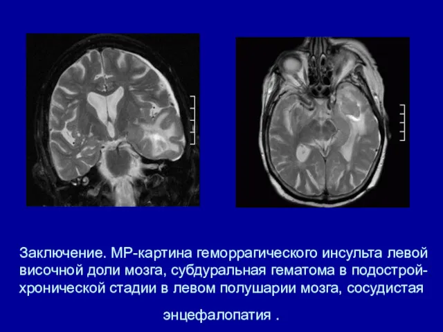 Заключение. МР-картина геморрагического инсульта левой височной доли мозга, субдуральная гематома