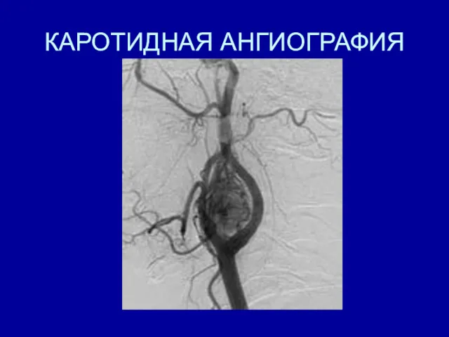 КАРОТИДНАЯ АНГИОГРАФИЯ