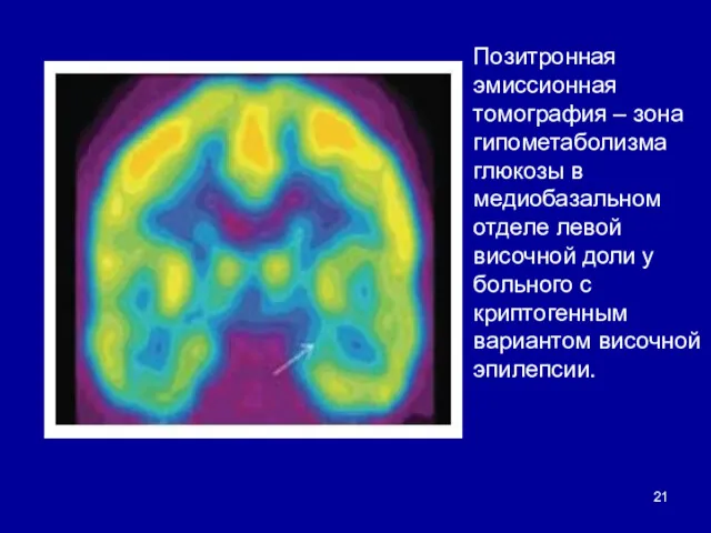 Позитронная эмиссионная томография – зона гипометаболизма глюкозы в медиобазальном отделе