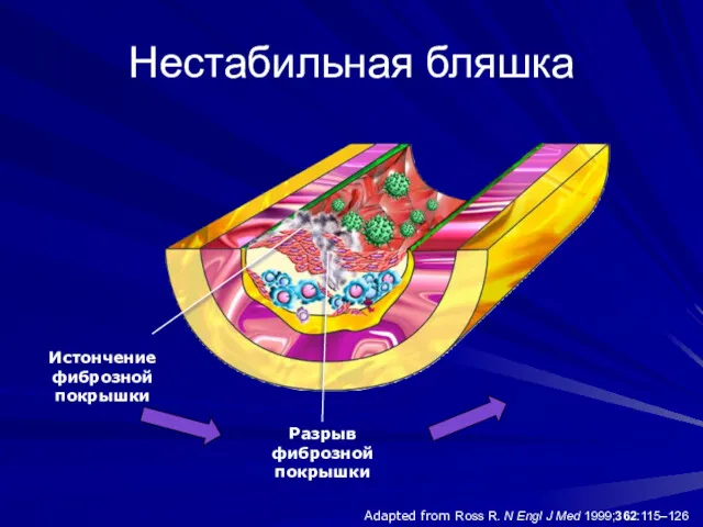 Adapted from Ross R. N Engl J Med 1999;362:115–126 Нестабильная бляшка Разрыв фиброзной