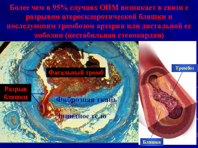 Более чем в 95% случаях ОИМ возникает в связи с разрывом атеросклеротической бляшки