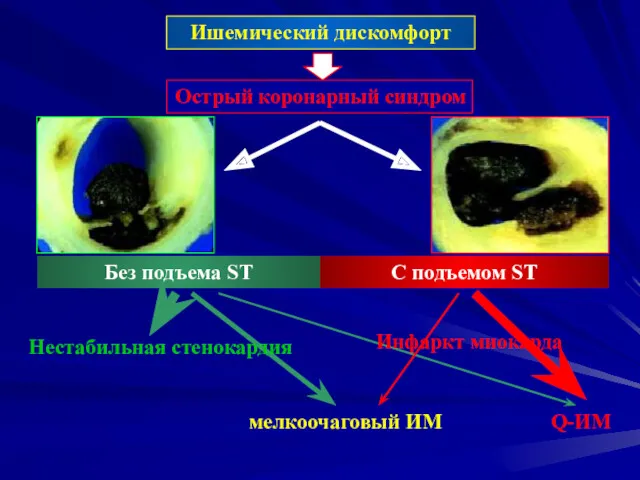 Ишемический дискомфорт Острый коронарный синдром C подъемом ST Без подъема ST мелкоочаговый ИМ