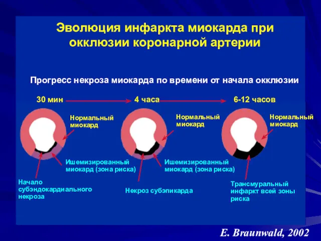 Эволюция инфаркта миокарда при окклюзии коронарной артерии Прогресс некроза миокарда по времени от