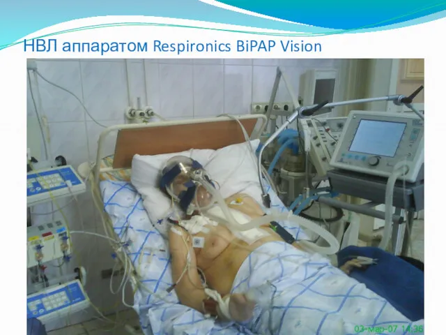 НВЛ аппаратом Respironics BiPAP Vision