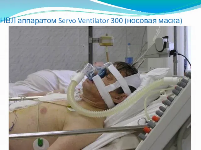 НВЛ аппаратом Servo Ventilator 300 (носовая маска)