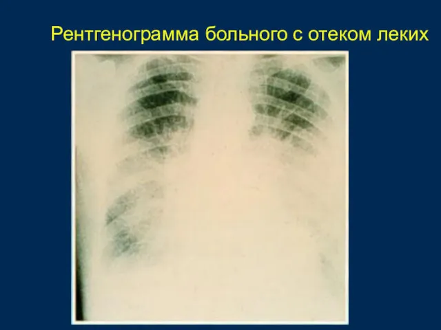 Рентгенограмма больного с отеком леких