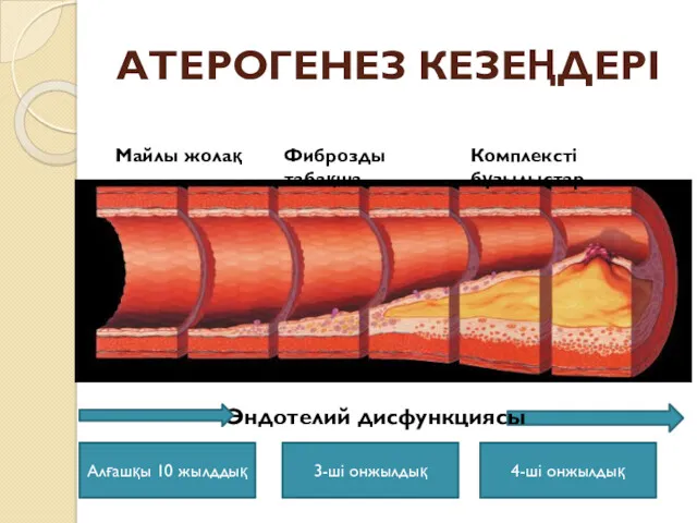 АТЕРОГЕНЕЗ КЕЗЕҢДЕРІ Майлы жолақ Фиброзды табақша Комплексті бұзылыстар Эндотелий дисфункциясы