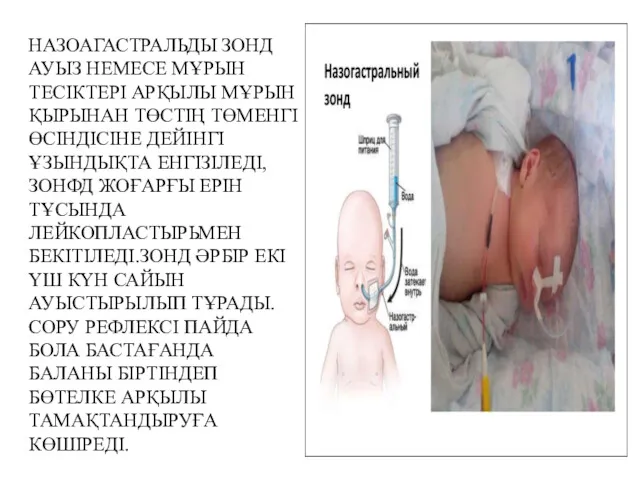 НАЗОАГАСТРАЛЬДЫ ЗОНД АУЫЗ НЕМЕСЕ МҰРЫН ТЕСІКТЕРІ АРҚЫЛЫ МҰРЫН ҚЫРЫНАН ТӨСТІҢ