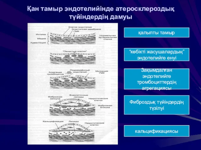 Қан тамыр эндотелийінде атеросклероздық түйіндердің дамуы қалыпты тамыр Зақымдалған эндотелийге