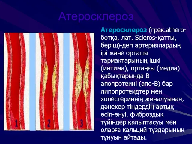 Атеросклероз Атеросклероз (грек.athero-ботқа, лат. Scleros-қатты, беріш)-деп артериялардың ірі және орташа