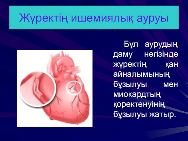 Жүректің ишемиялық ауруы Бұл аурудың даму негізінде жүректің қан айналымының бұзылуы мен миокардтың қоректенуінің бұзылуы жатыр.