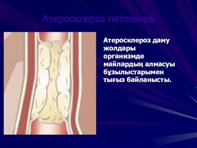 Атеросклероз патогенезі Атеросклероз даму жолдары организмде майлардың алмасуы бұзылыстарымен тығыз байланысты.