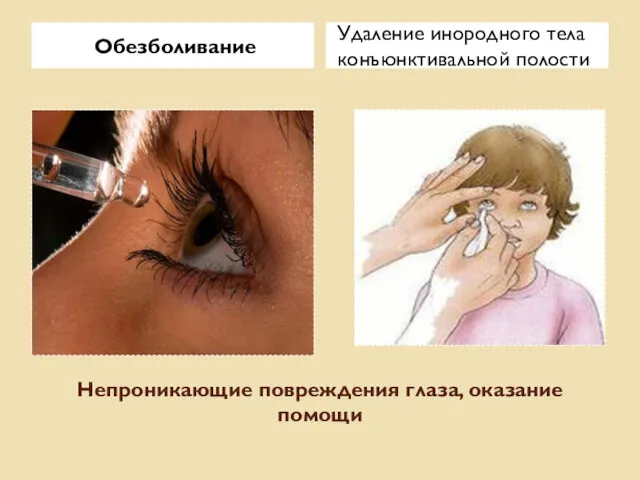 Непроникающие повреждения глаза, оказание помощи Обезболивание Удаление инородного тела конъюнктивальной полости