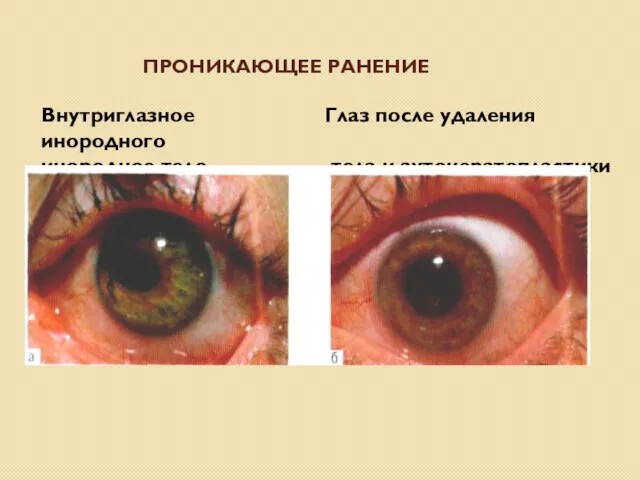 ПРОНИКАЮЩЕЕ РАНЕНИЕ Внутриглазное Глаз после удаления инородного инородное тело тела и аутокератопластики