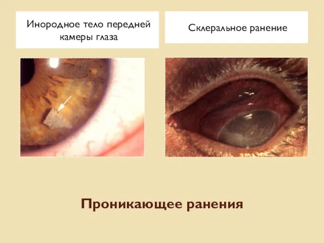 Проникающее ранения Инородное тело передней камеры глаза Склеральное ранение