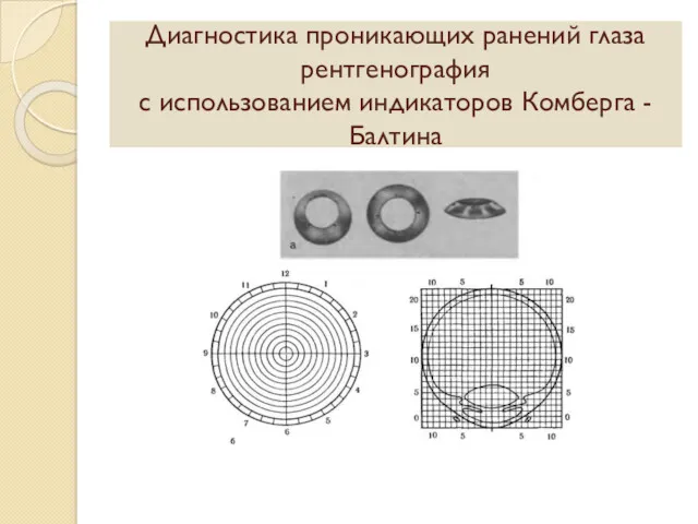 Диагностика проникающих ранений глаза рентгенография с использованием индикаторов Комберга - Балтина