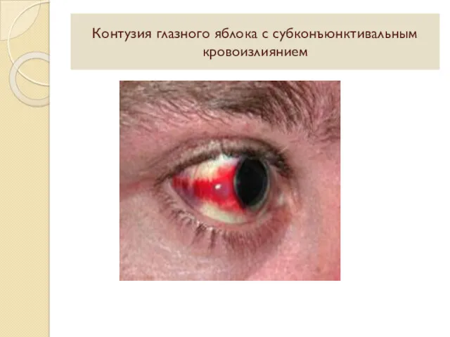 Контузия глазного яблока с субконъюнктивальным кровоизлиянием