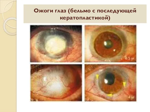 Ожоги глаз (бельмо с последующей кератопластикой)
