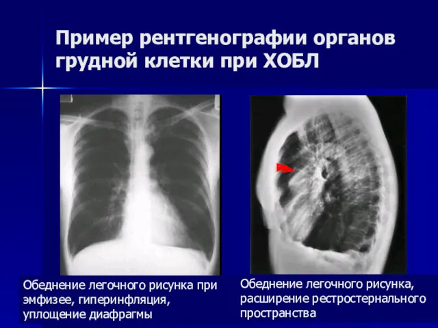 Пример рентгенографии органов грудной клетки при ХОБЛ Обеднение легочного рисунка