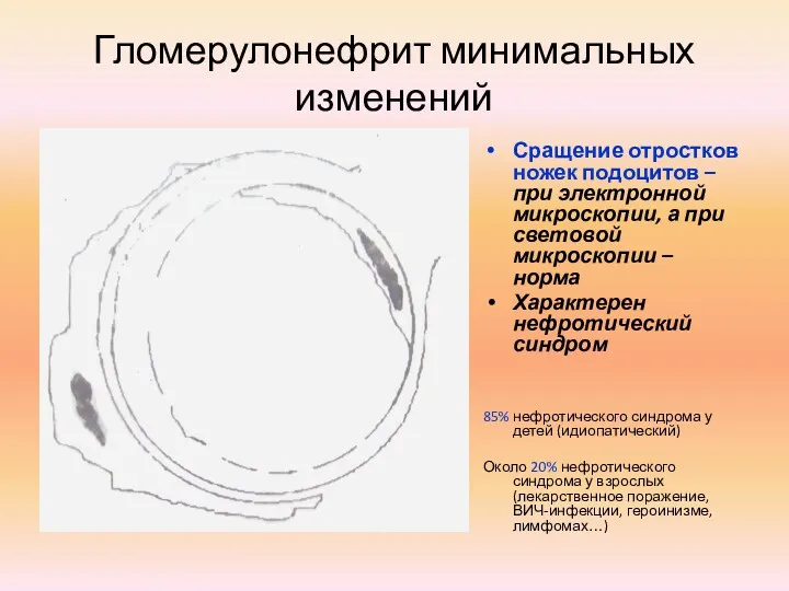 Гломерулонефрит минимальных изменений Сращение отростков ножек подоцитов – при электронной