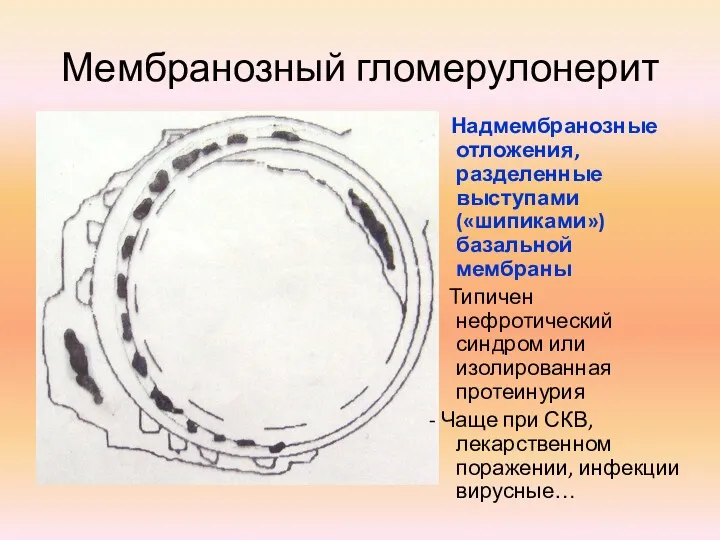 Мембранозный гломерулонерит Надмембранозные отложения, разделенные выступами («шипиками») базальной мембраны Типичен