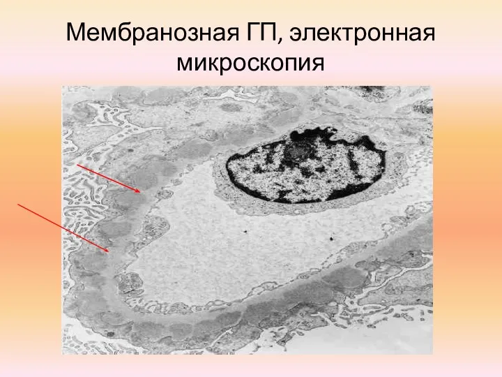 Мембранозная ГП, электронная микроскопия