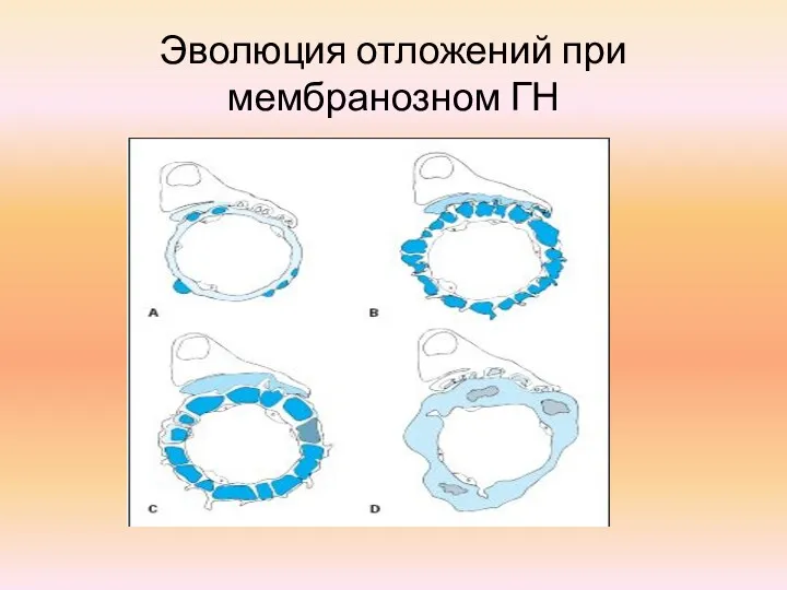 Эволюция отложений при мембранозном ГН