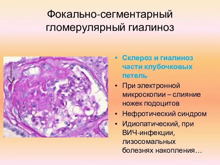 Фокально-сегментарный гломерулярный гиалиноз Склероз и гиалиноз части клубочковых петель При