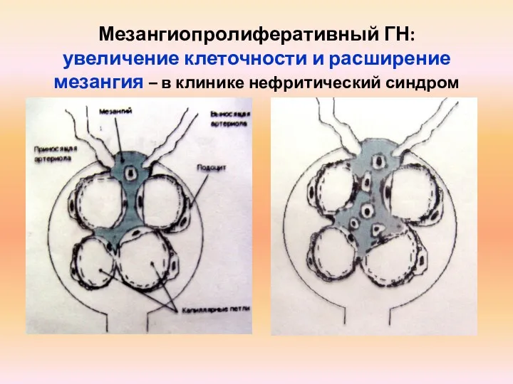 Мезангиопролиферативный ГН: увеличение клеточности и расширение мезангия – в клинике нефритический синдром