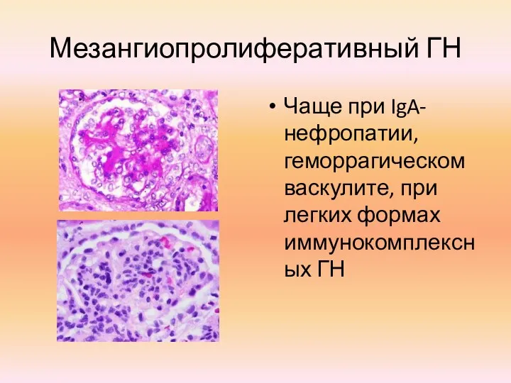 Мезангиопролиферативный ГН Чаще при IgA-нефропатии, геморрагическом васкулите, при легких формах иммунокомплексных ГН