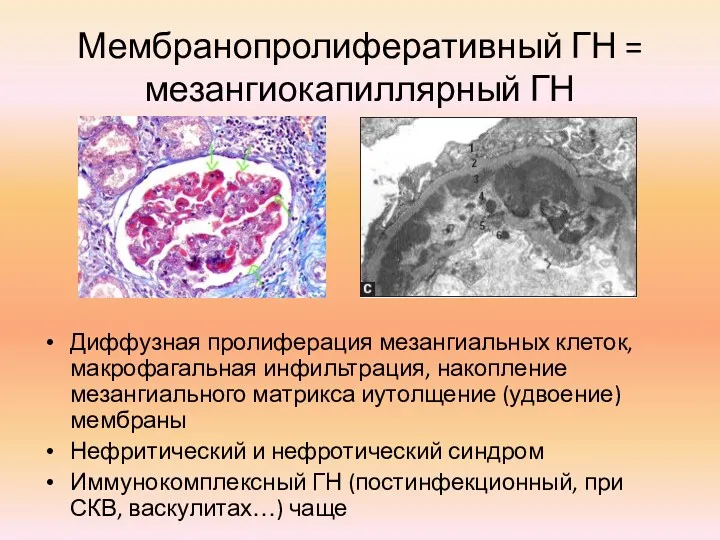 Мембранопролиферативный ГН = мезангиокапиллярный ГН Диффузная пролиферация мезангиальных клеток, макрофагальная