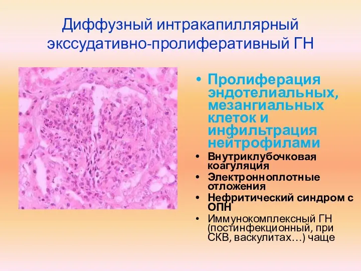 Диффузный интракапиллярный экссудативно-пролиферативный ГН Пролиферация эндотелиальных, мезангиальных клеток и инфильтрация