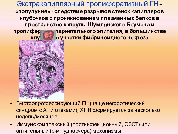 Экстракапиллярный пролиферативный ГН – «полулуния» - следствие разрывов стенок капилляров