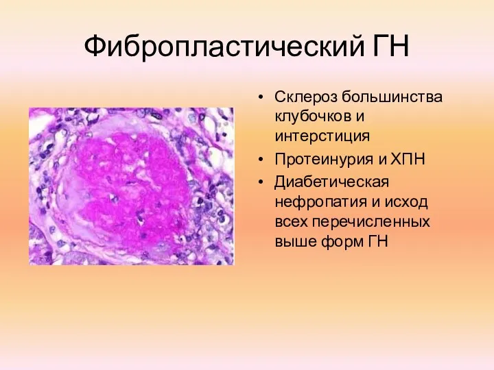 Фибропластический ГН Склероз большинства клубочков и интерстиция Протеинурия и ХПН