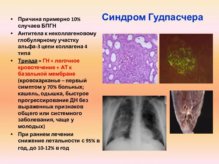 Синдром Гудпасчера Причина примерно 10% случаев БПГН Антитела к неколлагеновому