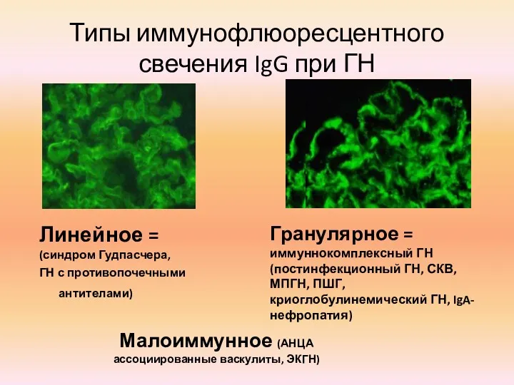 Типы иммунофлюоресцентного свечения IgG при ГН Линейное = (синдром Гудпасчера,